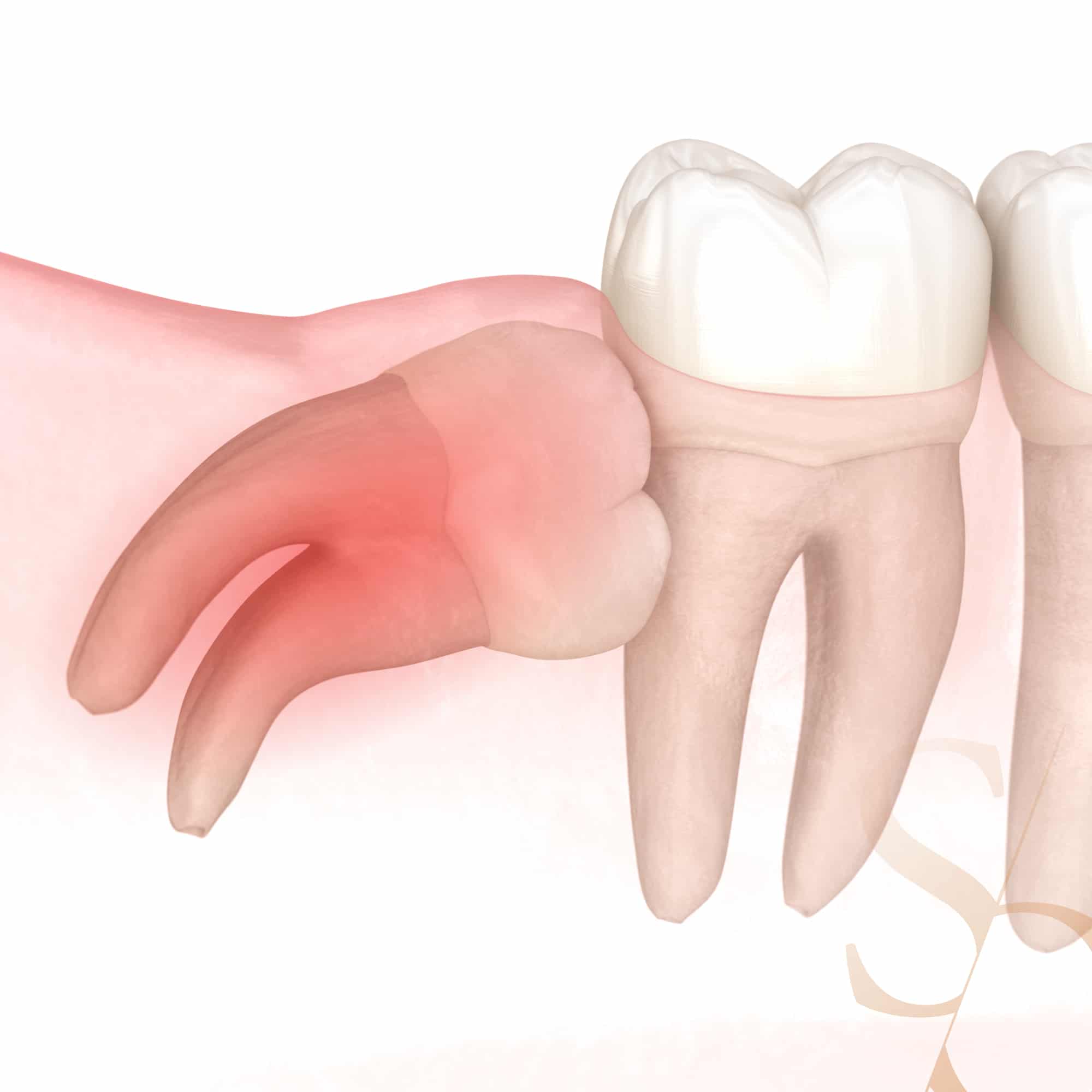 Trou dans la bouche : comprendre l’impact des dents de sagesse post thumbnail image